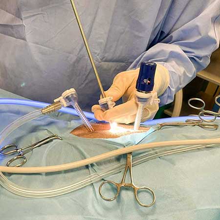 La Chirurgie Mini-Invasive